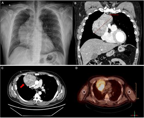 Images Of The Mediastinal Mass A Chest X Ray Showing A Lobulated Right