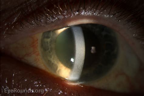 Corneal And Lenticular Pigmentation From Long Term Chlorpromazine Use