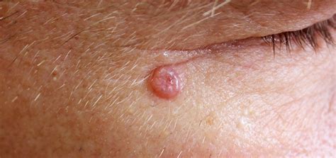 Superficial Basal Cell Carcinoma Nose