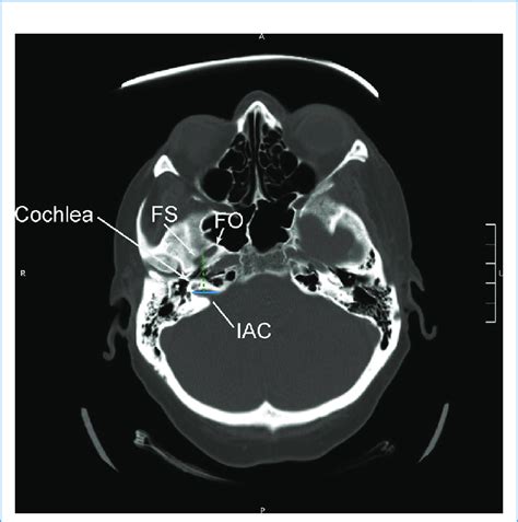 Computed Tomographic Scan Depicting The Application Of The Cochlear