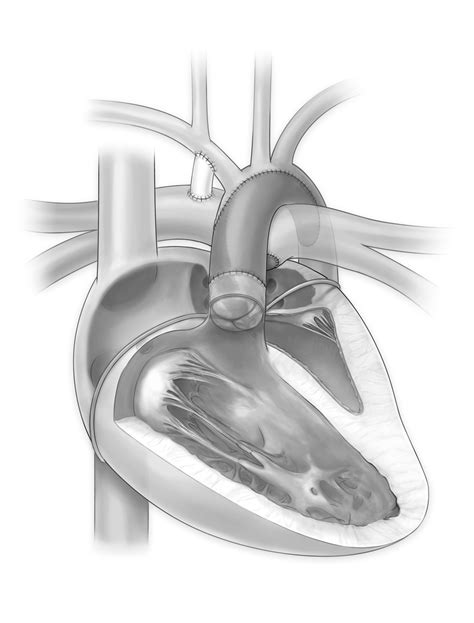 Hypoplastic Left Heart Syndrome Stage 1 Palliation Online Supplement