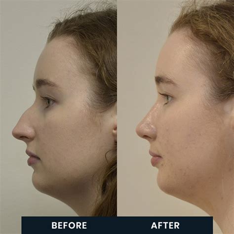 Rhinoplasty Surgery What To Do Immediately After Your Rhinoplasty Dr