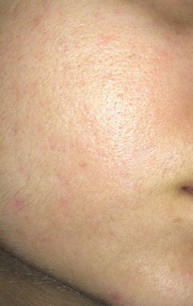 Co2 For Removing Scars Pink Spots On Cheek Still After A Month And