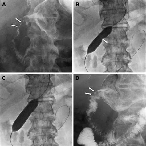 Balloon Dilation And Stent Placement For An Anastomotic Stricture In A
