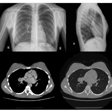 Posterioanterior And Lateral Chest Radiographs Demonstrating