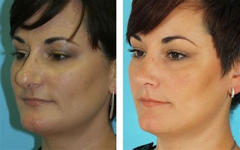 Nose Reconstruction Plastic Surgery Photos Before And After