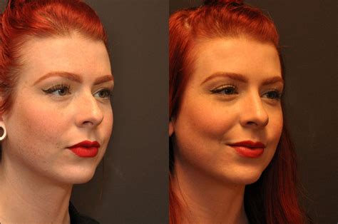 Rhinoplasty Nose Reshaping Photos Cincinnati Oh Patient 6814