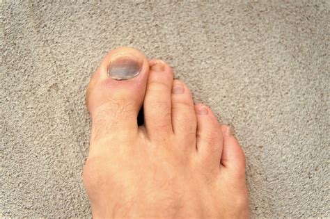 Foot Injury Ankle And Foot Centers Of Georgia West Cobb