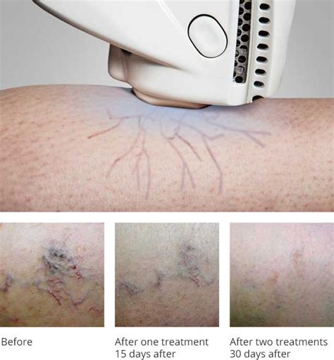 Vascular Laser Vein Removal Treatment With Exotherme Auckland Nz
