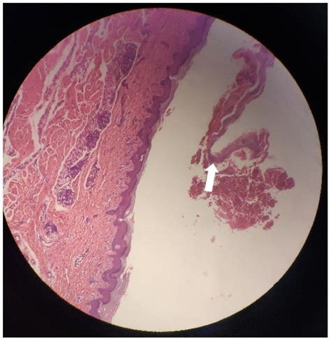 Diagnosis Fetal Risk And Treatment Of Pemphigoid Gestationis In