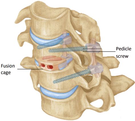 Cervical Discectomy And Fusion
