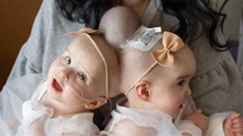 Conjoined Twins Successfully Separated In Landmark Surgery That Took