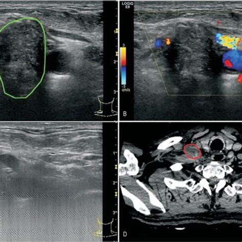 A Ultrasound Image Shows Lymph Node Metastasis Inside The Green