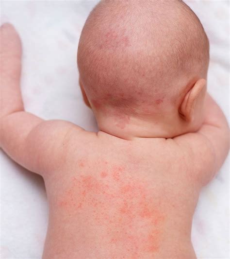 Safe Ways To Soothe Heat Rash On Babys Face Pregnant Education