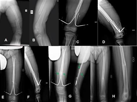 9 Year Old Child Fell From The Scooter Diaphyseal Fracture Of The Left