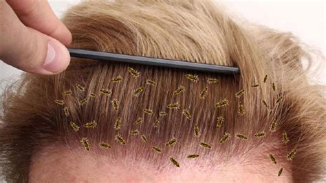 What Lice And Their Eggs Look Like Youtube