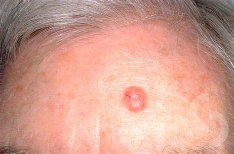 Basal Cell Carcinoma Rodent Ulcer On The Cheek Also S Vrogue Co