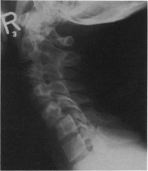 Case One Neutral Lateral View Of Cervical Spine Showing A Forward