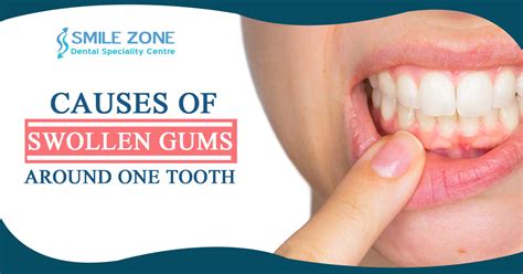 Swollen Gums Around One Tooth Causes