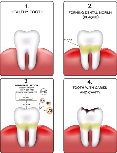 Dental Cavities Pictures