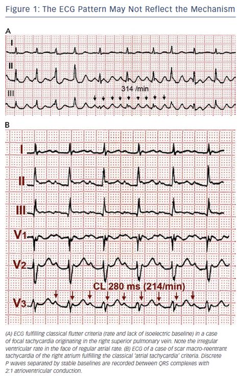 Ecg With Atypical Atrial Flutter With Negative Flutter Images
