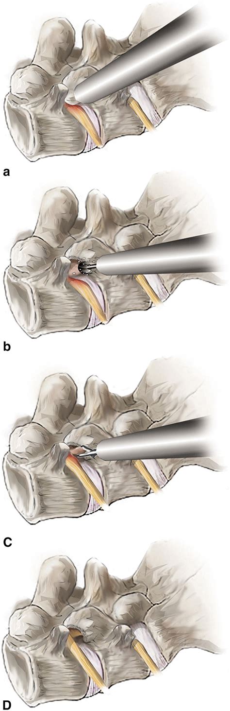 Schematic Illustrations Depicting The Surgical Procedure Of