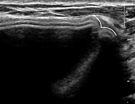Multimodality Imaging Based Evaluation Of Single Lumen Silicone Breast