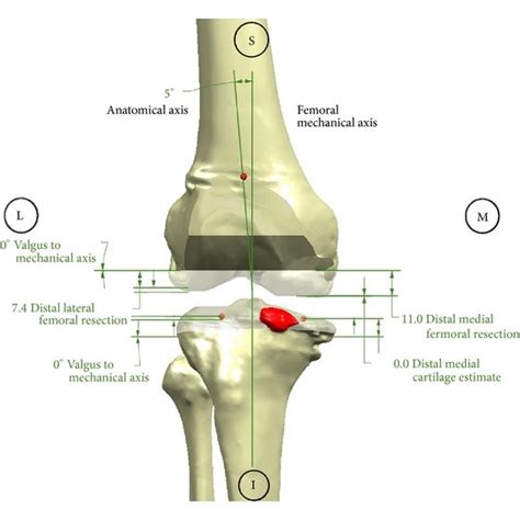 A Femoral Cutting Guide After Placement On The Distal Femur B