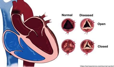 Rheumatic Heart Disease Cardiology Rheumatic Fever Heart Muscle