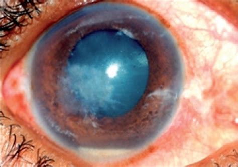 Keratitis Causes Symptoms Diagnosis Prevention Treatment