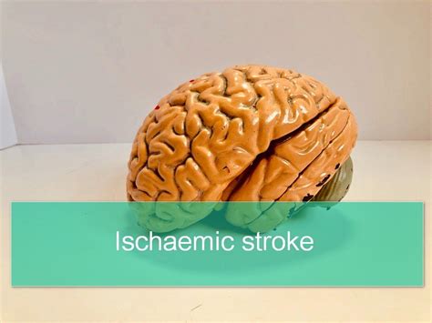 Ischaemic Stroke Pathophysiology Signs And Treatment Medcrine