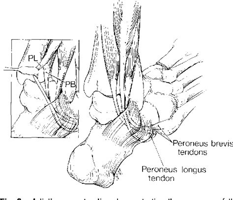 Figure 2 From Chronic Peroneal Tendon Subluxation Produced By An