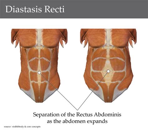 Losing Your Mom Belly What Is Diastasis Rectus Abdominis Birth You