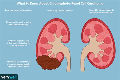 Chromophobe Renal Cell Carcinoma Treatment Causes And More