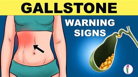 Gallbladder Stones Symptoms Cholelithiasis Gallstones Symptoms Gallstones Warning Signs