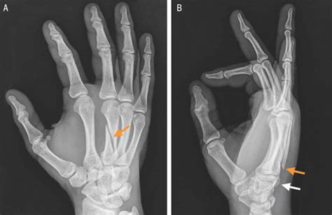 Acute Fracture Of The Third Metacarpal In A Handball Player Journal