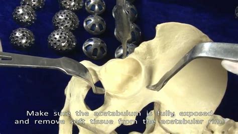 Diamond Hip Replacement System Uncemented Youtube