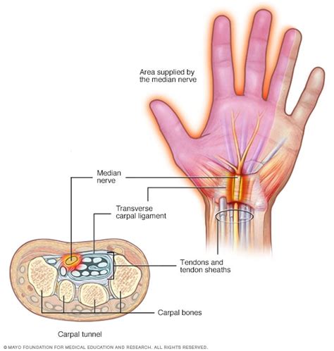 Pinched Nerve Symptoms And Causes Mayo Clinic