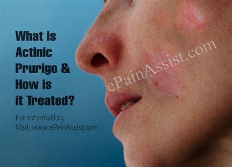 What Is Actinic Prurigo And How Is It Treated