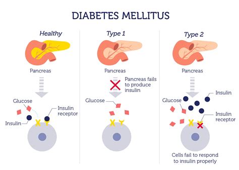 Learn more about the different types of diabetes mellitus. DNA Type 2 Diabetes Test | DNA in the News