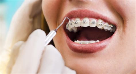 Orthodontic Treatment Increases In Popularity Amongst Adults