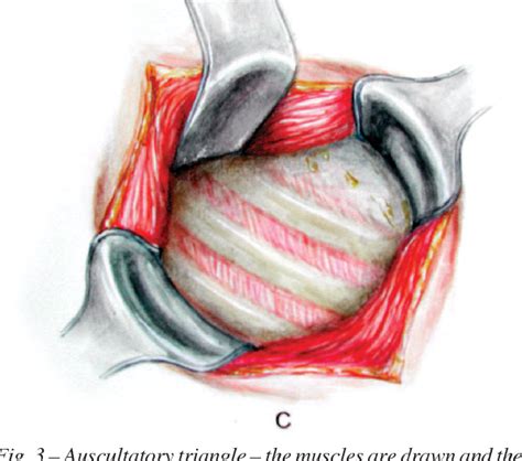 Pdf Minimally Invasive Thoracotomy Muscle Sparing Thoracotomy For