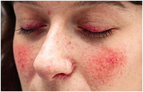 20 Interesting Facts About Rosacea And Its Causes Symptoms Diagnosis