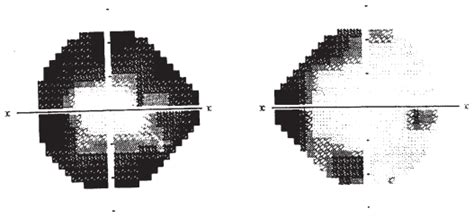 Humphrey Visual Field Map Of A Patient Treated With Vigabatrin Vgb