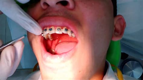 Watch How We Put Your Braces Youtube