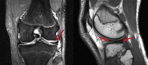 A Coronal T2 Magnetic Resonance Image Of The Left Knee Left Showing
