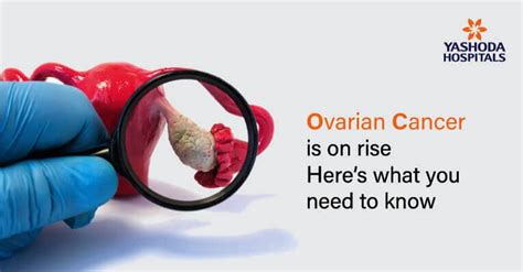 Ovarian Cancer Causes Symptoms Diagnosis And Treatments