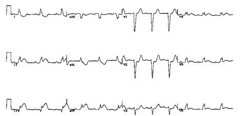 Acute Inferior Myocardial Infarction In The Presence Of Lbbb