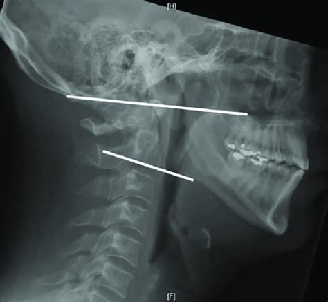 Lateral X Ray Of The Cervical Spine Demonstrating The O C2 Angle It Is