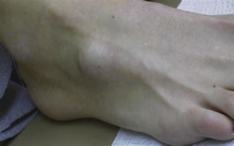 What Is A Ganglion Cyst Agoura Los Robles Podiatry Centers